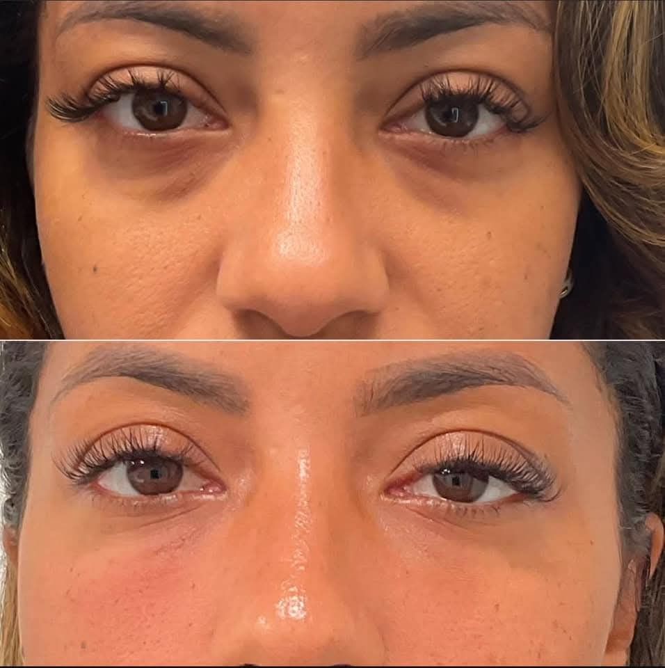 RENOVA Lift Contorno™